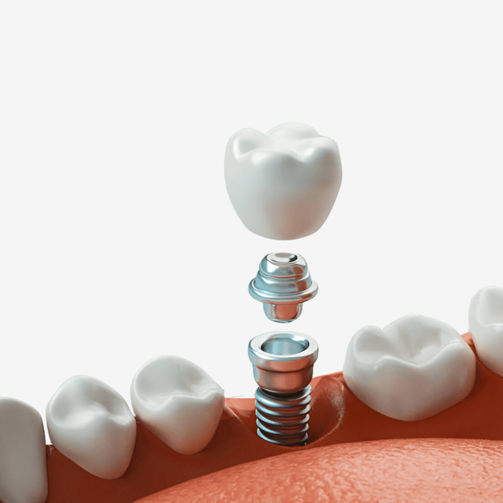 Dental Implants