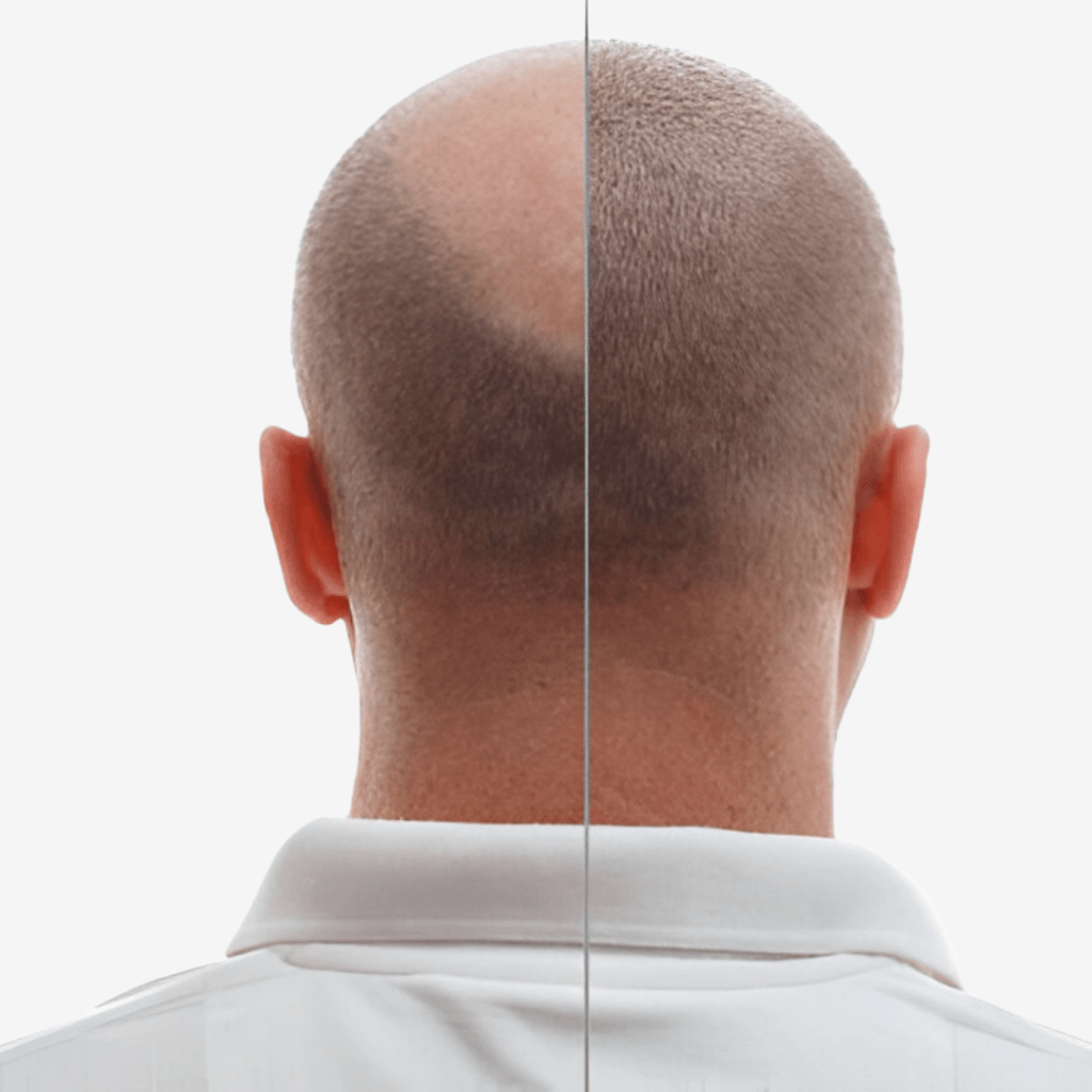 Hair Transplants