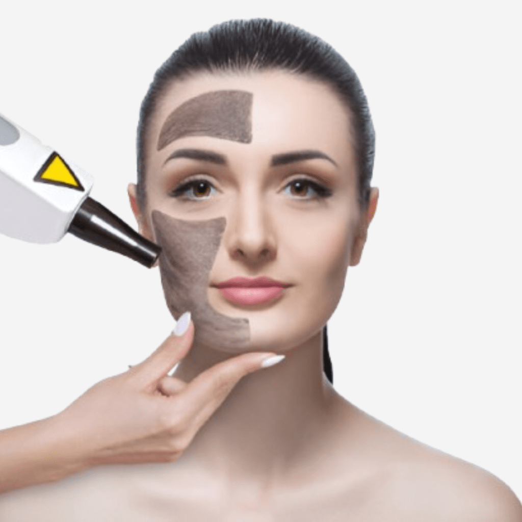 Laser Pigmentation and Dark Spot Removal
